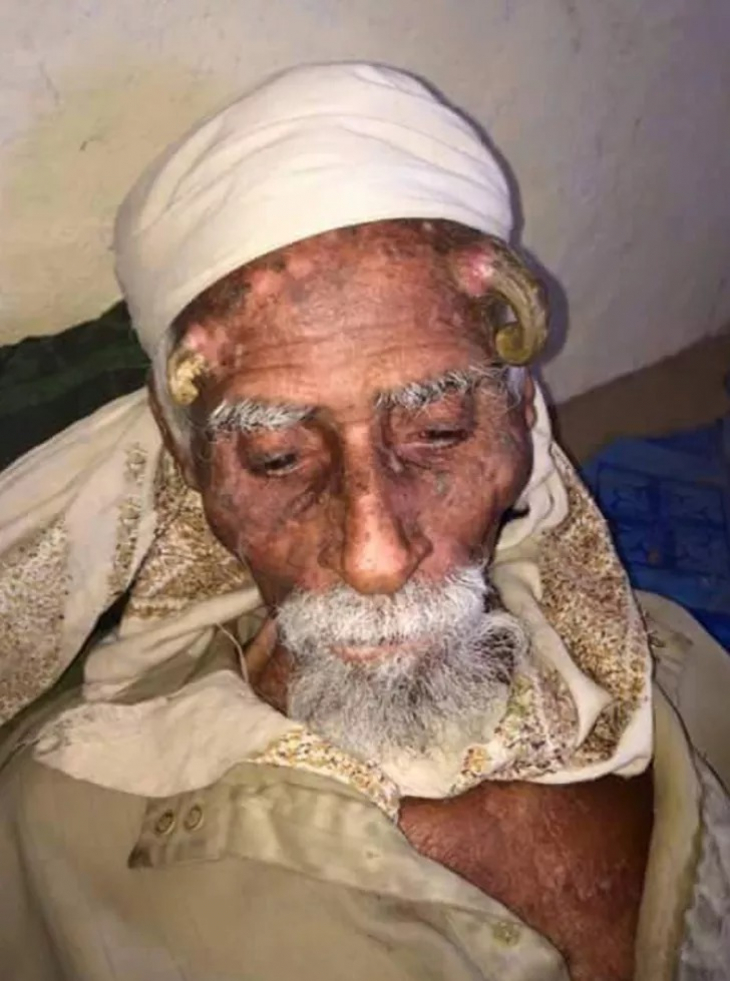 Kafasında boynuz çıkmıştı! 'Dünyanın en yaşlı adamı', onları kesmek için yapılan başarısız bir operasyondan sonra 140 yaşında öldü