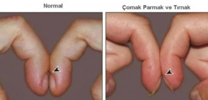 Hemen parmaklarınızı kontrol edin: Parmaklarda ortaya çıkan bu belirti o hastalığın habercisi olabilir