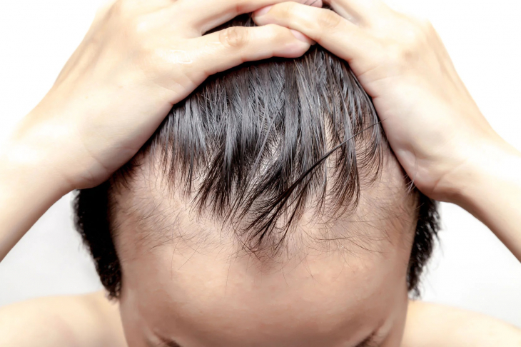 Saç Dökülmesi Hangi Vitamin Eksikliğinde Olabilir?