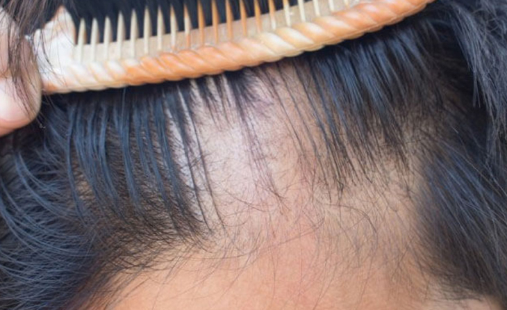 Saç Dökülmesi Hangi Vitamin Eksikliğinde Olabilir?