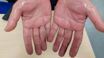 'İşaret parmağı uzun olanlarda kalp krizi yüksek olabilir' uyarısı