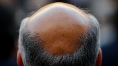 Saçı olmayanlara müjde: Bu bant dökülen saçları geri çıkarıyor