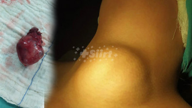 Siirt'te hastanın boynundan dev guatr çıkarıldı