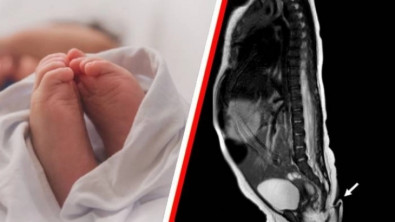 Tıp dünyası şaşkın! Meksika'da bir bebek kuyruklu doğdu